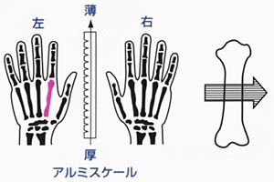手のレントゲン画像から、骨粗しょう症の検査を行うシステムです